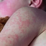 CDC-Responds-as-Texas-Measles-Outbreak-Reaches-159-Cases